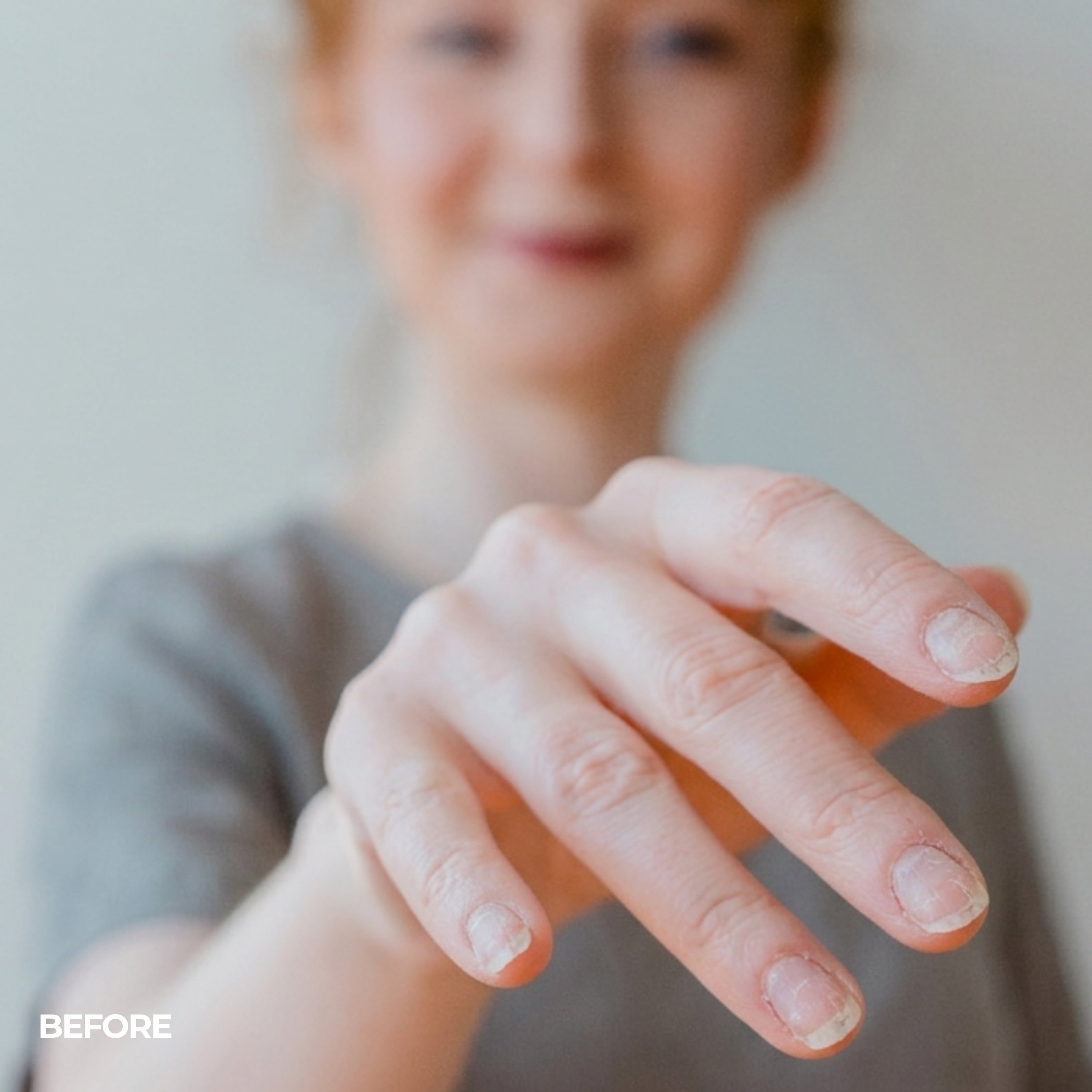 Nails before treatment — peeling and damaged